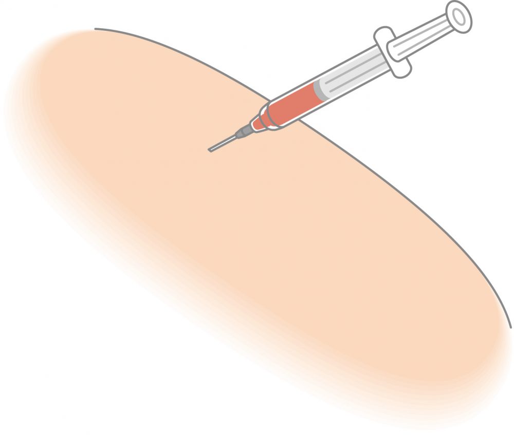 インフルエンザ予防接種で腕が腫れる場合 副作用 どうすればいい